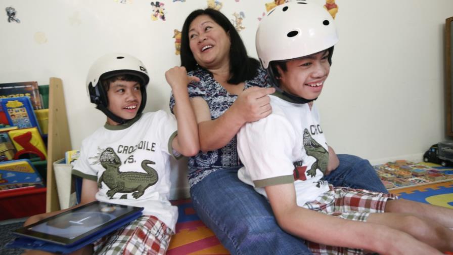 Diez años después, vidas separadas para siameses