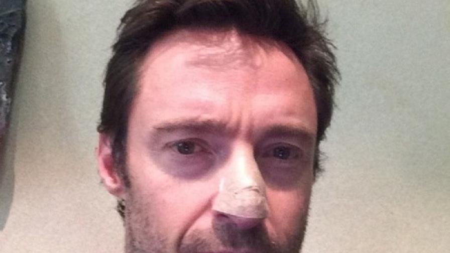 Hugh Jackman es tratado por segunda vez de un carcinoma en la nariz