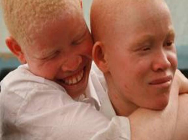 Investigadora de UASD descubre nuevos genes sobre el albinismo