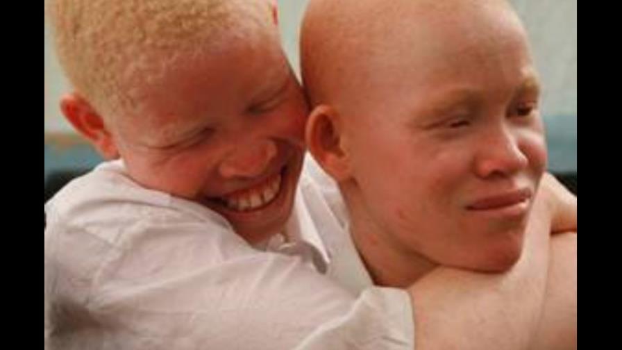 Investigadora de UASD descubre nuevos genes sobre el albinismo Investigadora de UASD descubre nuevos genes sobre el albinismo