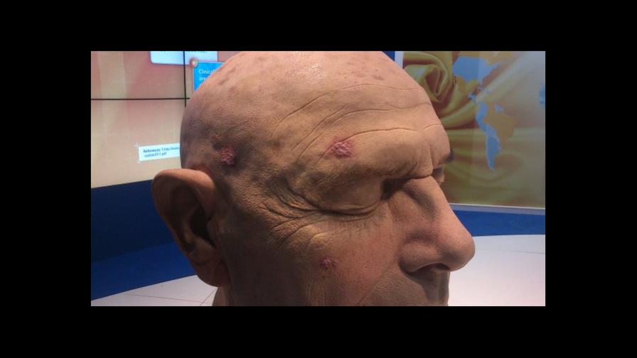 Medicamento para psoriasis supera pruebas
