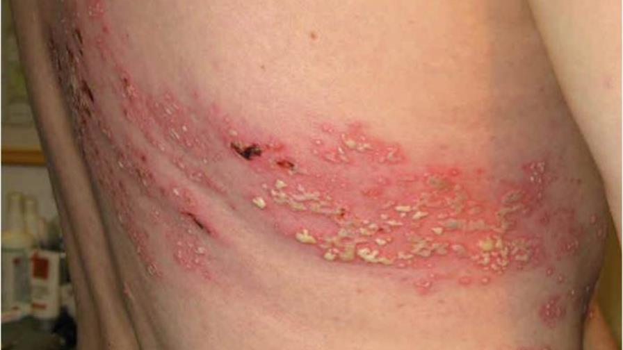 Vacuna del herpes zoster Vacuna del herpes zoster