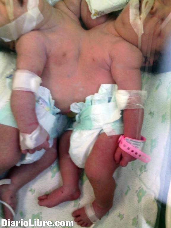 Empeora salud de siamesas nacidas en hospital de Santiago