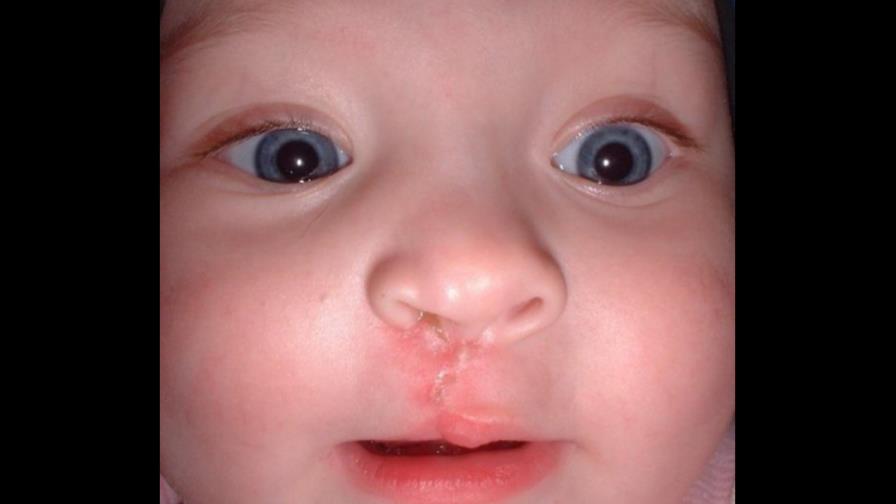 Labio Leporino y la técnica NAM