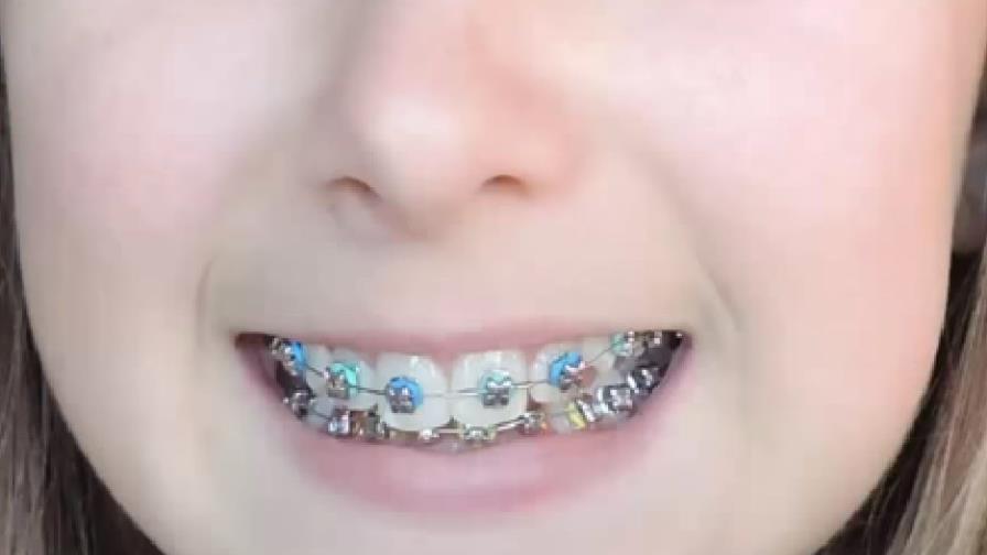 Sociedad de Ortodoncia advierte sobre los braces de lujos en el país