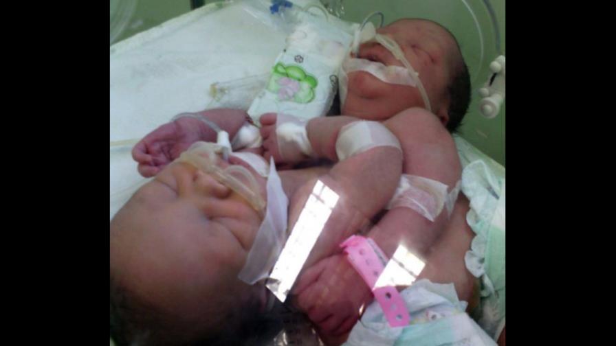 Fallecen las siamesas que nacieron en Santiago