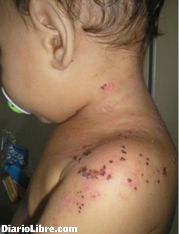 Casos de varicela afectan a niños del Gran Santo Domingo