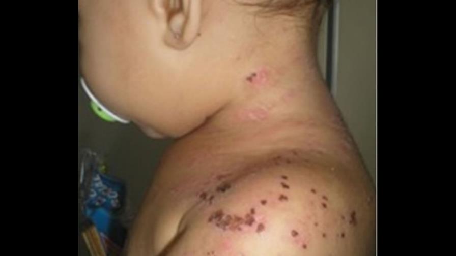 Casos de varicela afectan a niños del Gran Santo Domingo