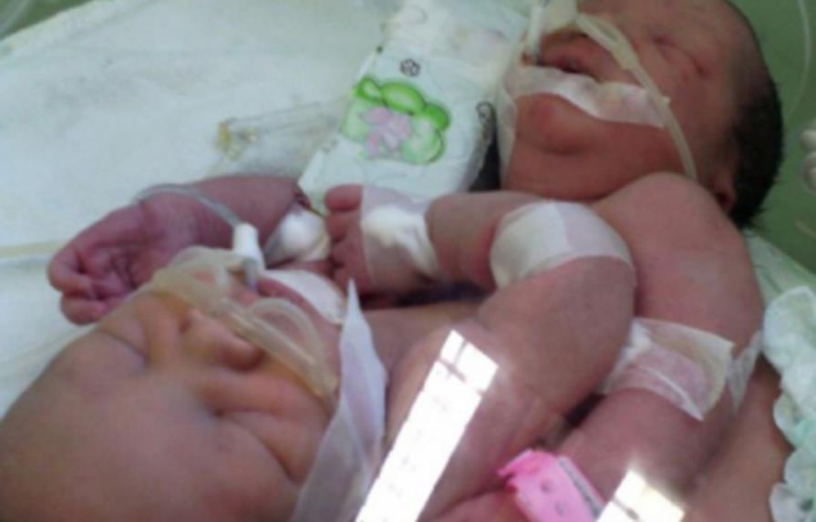 Empeora salud de siamesas nacidas en Santiago